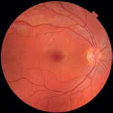 Retinal fundus image analyzed by Aireen
